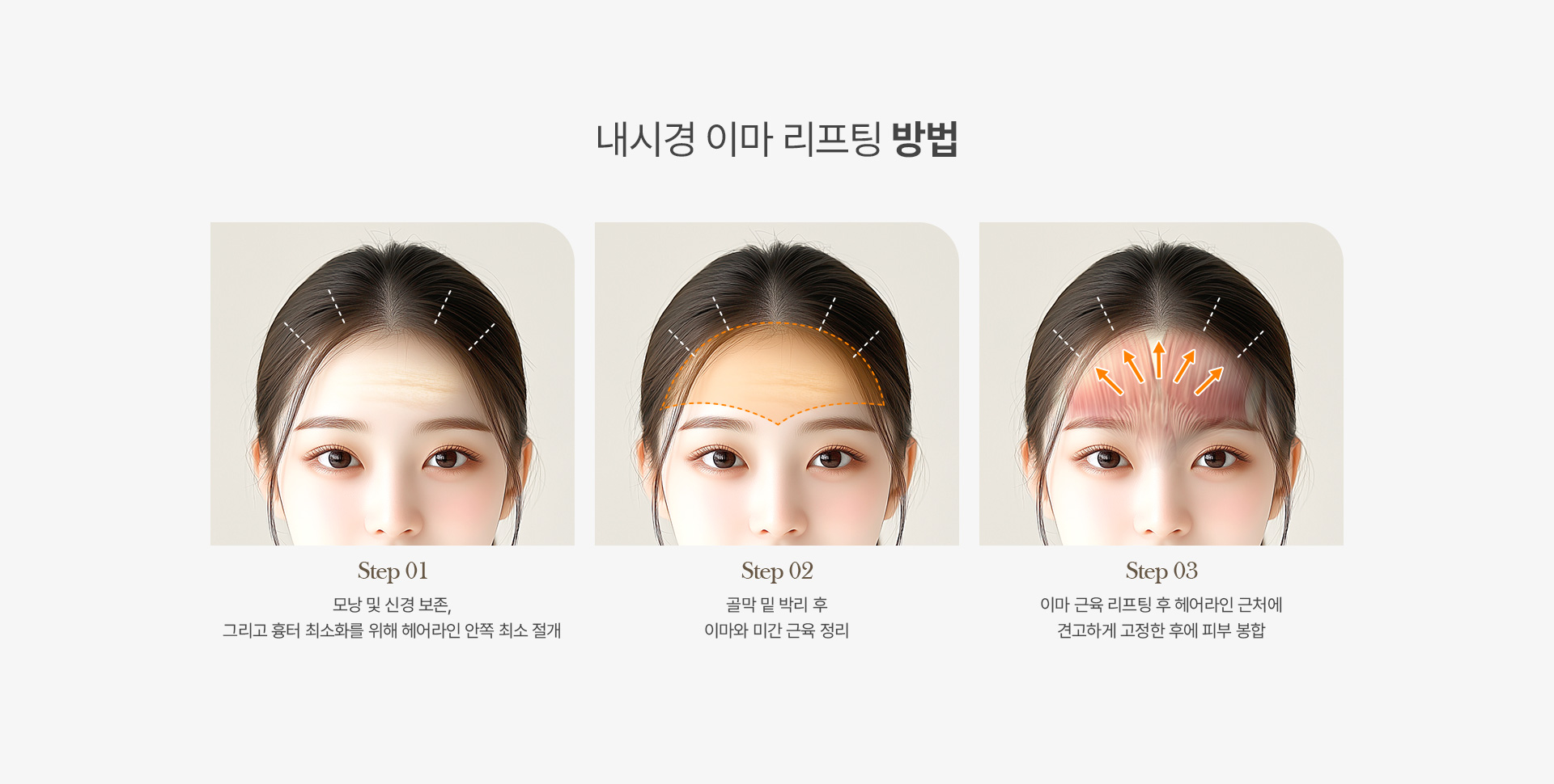 내시경이마리프팅 03