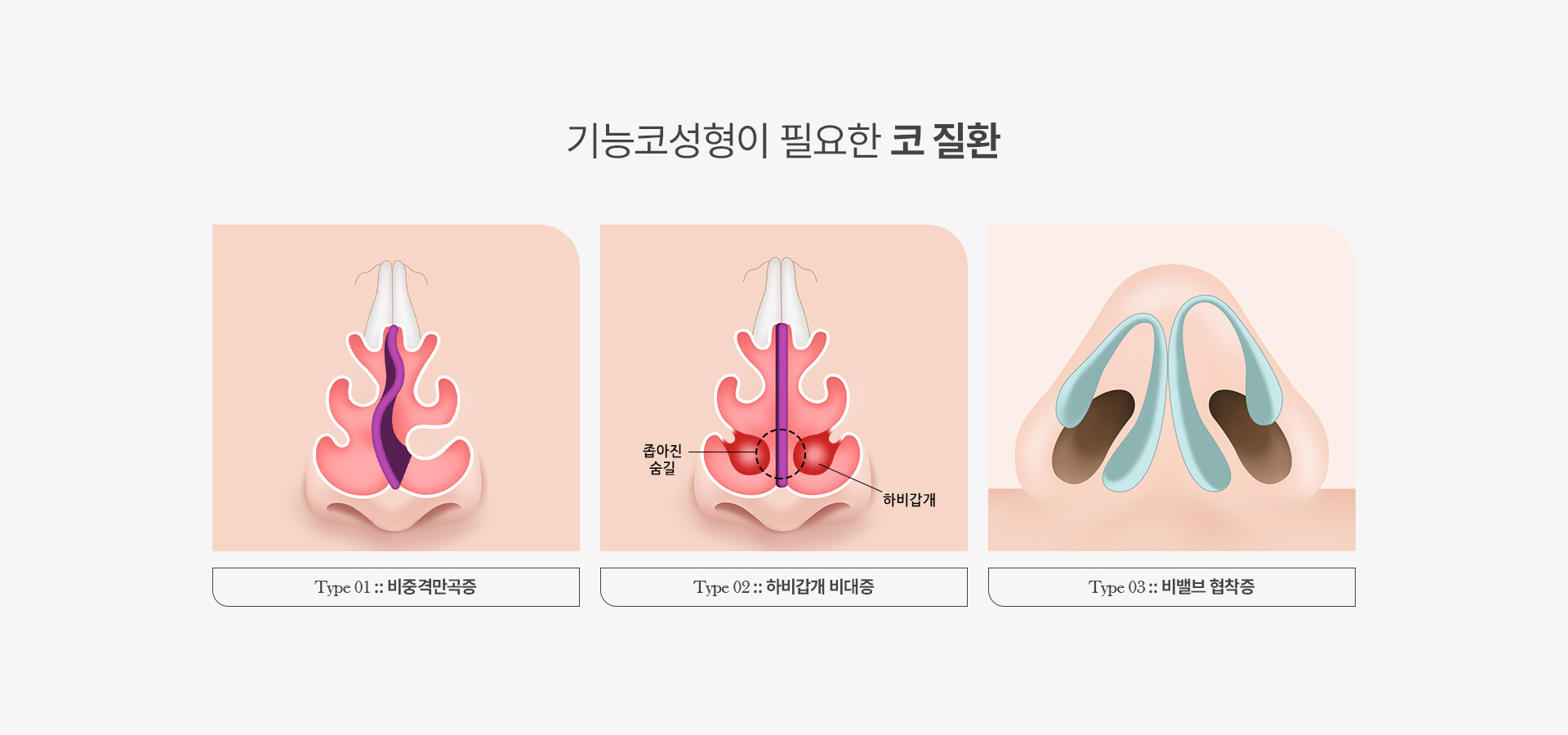 기능코성형 03